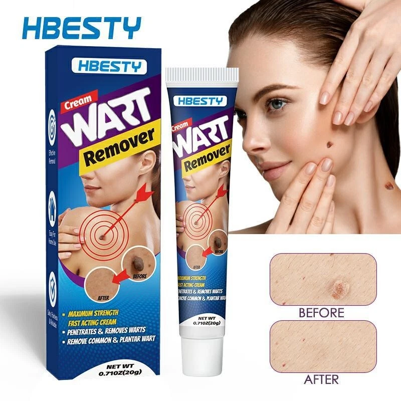 Warts Removal Cream